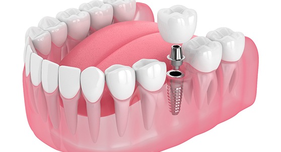 diagram of dental implant and abutment