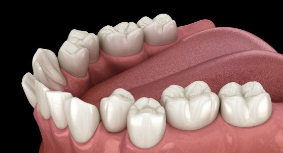 Illustration of crooked teeth