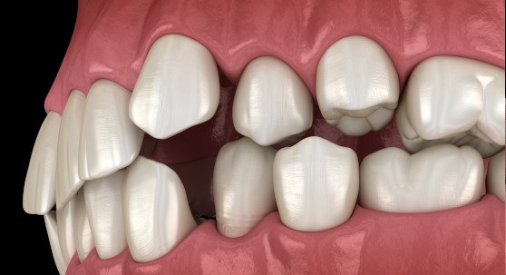 Illustration of gapped teeth